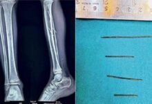 टायर फटने से बच्चे के पैरों में धंसे लोहे के 4 टुकड़े