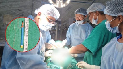 जेल में बंद कैदी ने पेशाब नली में डाला 9cm लंबा पेंसिल