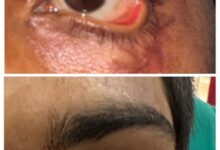 स्किन ग्राफ्टिंग से मरीज के पलक का सफल पुनर्निर्माण