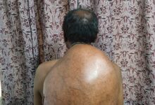 अम्बेडकर अस्पताल के सर्जरी विभाग की ऐतिहासिक उपलब्धि :10.30 किलोग्राम वजनी विशाल ट्यूमर का सफल ऑपरेशन