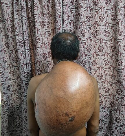 अम्बेडकर अस्पताल के सर्जरी विभाग की ऐतिहासिक उपलब्धि :10.30 किलोग्राम वजनी विशाल ट्यूमर का सफल ऑपरेशन
