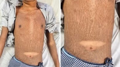 छत्तीसगढ़ में 19 साल के युवक में मिली दुर्लभ बीमारी, डॉक्टर भी हैरान