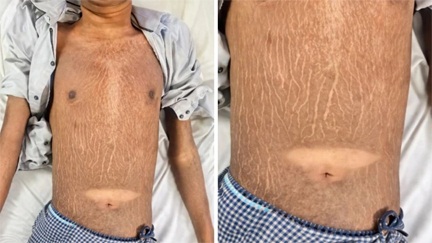 छत्तीसगढ़ में 19 साल के युवक में मिली दुर्लभ बीमारी, डॉक्टर भी हैरान