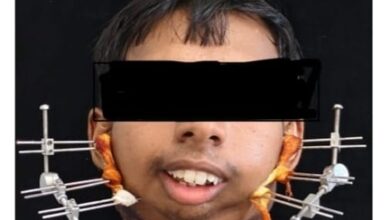 जटिल सर्जरी से खुला मुंह, आयुष्मान योजना से मिला निःशुल्क उपचार जटिल सर्जरी से खुला मुंह, आयुष्मान योजना से मिला निःशुल्क उपचार
