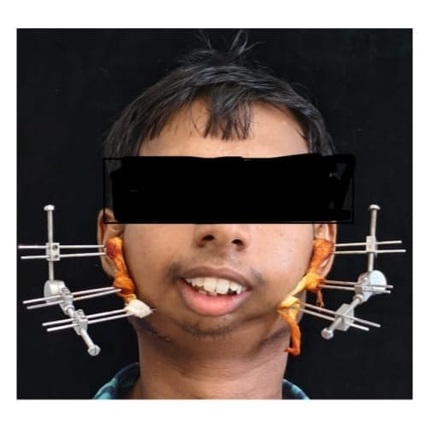 जटिल सर्जरी से खुला मुंह, आयुष्मान योजना से मिला निःशुल्क उपचार जटिल सर्जरी से खुला मुंह, आयुष्मान योजना से मिला निःशुल्क उपचार
