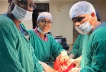रायगढ़ मेडिकल कॉलेज के चिकित्सकों की उपलब्धि : महिला के पेट से निकाला गया 8 किलोग्राम वजनी विशालकाय ट्यूमर